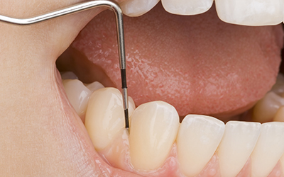 Dentist working on patients gums