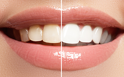 Teeth whitening